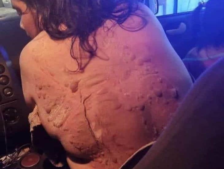 Esposo le lanza aceite caliente a mujer en Ixhuatlán; DIF interviene en caso