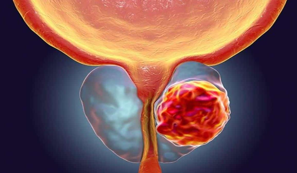 En México, han aumentado casos de cáncer prostático y testicular