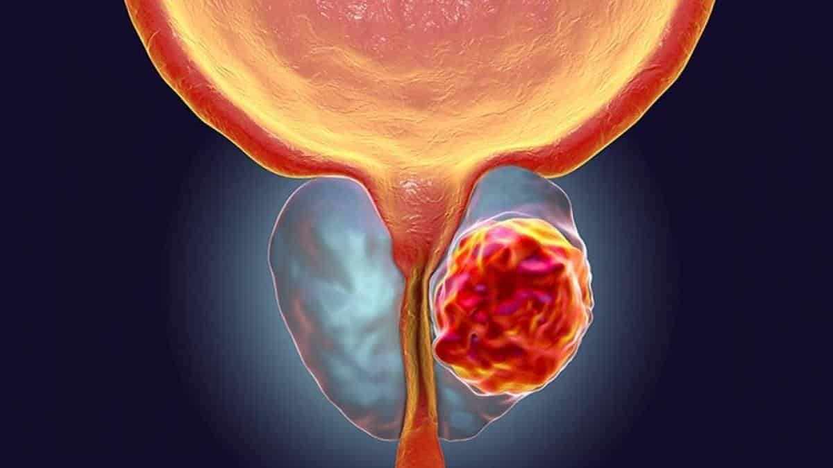 En México, han aumentado casos de cáncer prostático y testicular