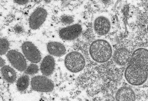 OMS evalúa declarar alerta sanitaria máxima por viruela del mono