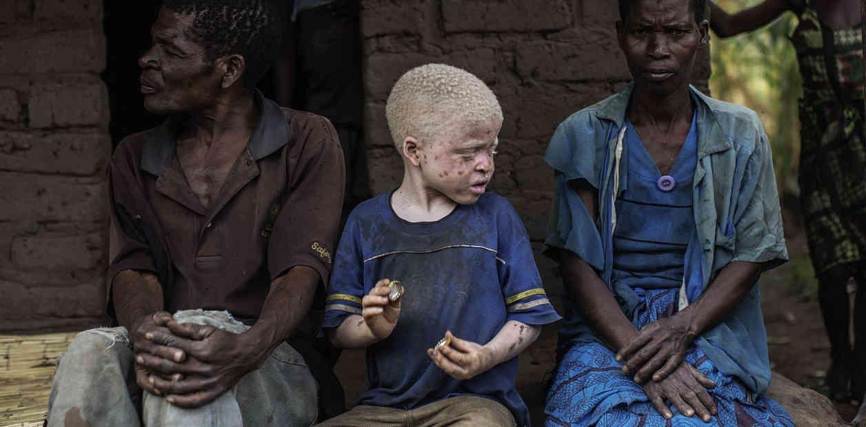 Detienen a hombre que intentó vender a sus hijos albinos para rituales de brujería