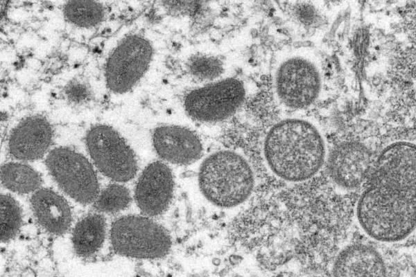 SSA confirma 60 casos de viruela del mono detectados en México; uno aún es sospechoso