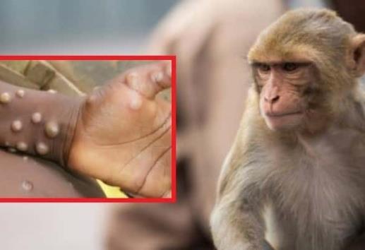 OPS alerta sobre América como nuevo epicentro de casos de viruela del mono