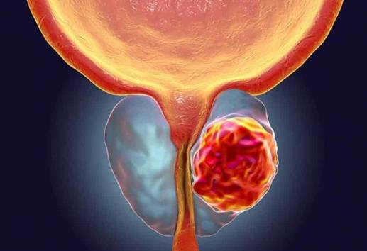 ¡Tú puedes prevenir el cáncer de próstata! Te decimos cómo