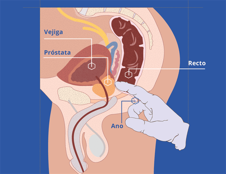 ¡Tú puedes prevenir el cáncer de próstata! Te decimos cómo