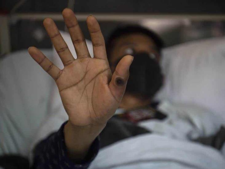 Veracruz registra ya 37 casos de viruela del mono; el país suma 3 mil 362
