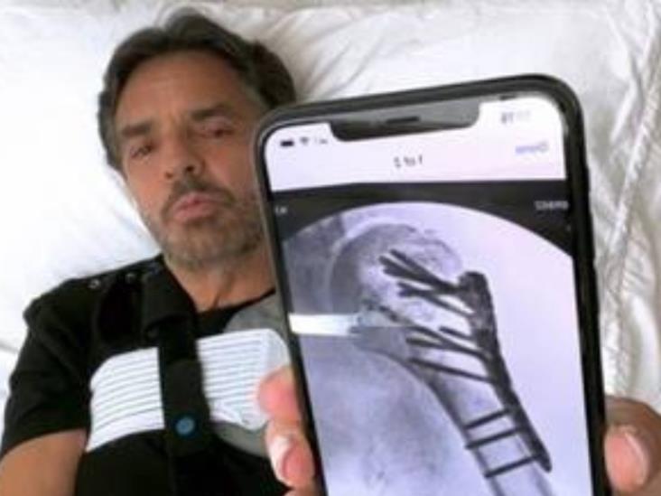 ¡Eugenio Derbez temía perder su brazo tras accidente!