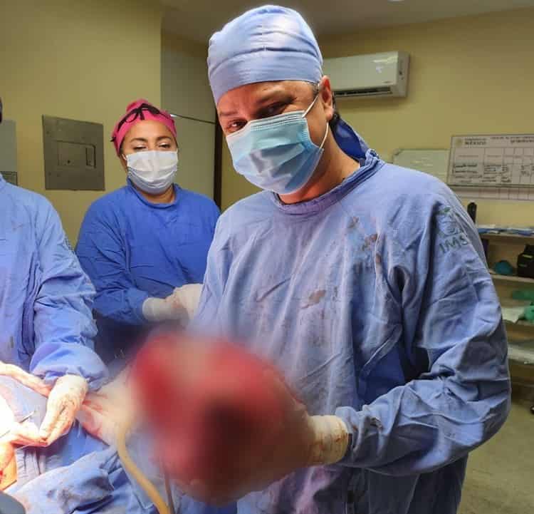 Extirpan, especialistas del IMSS Veracruz, tumor maligno de 13 kilos