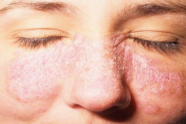Informa IMSS Veracruz Norte sobre síntomas y control de lupus eritematoso sistémico