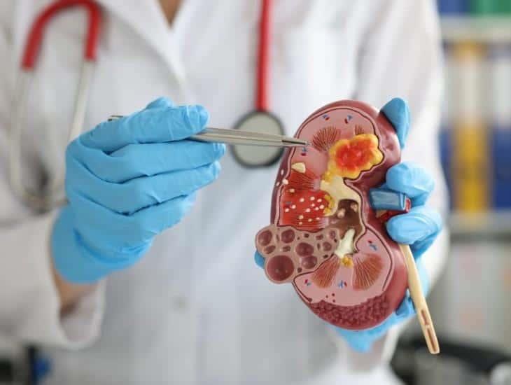 Enfermedad Renal Crónica afecta a más de 12 millones de mexicanos