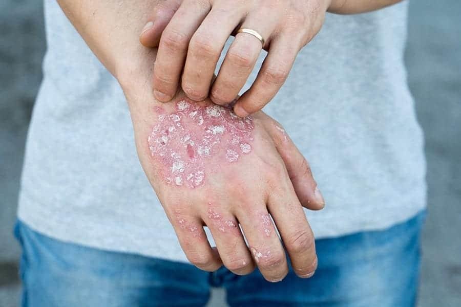 Psoriasis Pustular, enfermedad rara terriblemente dolorosa