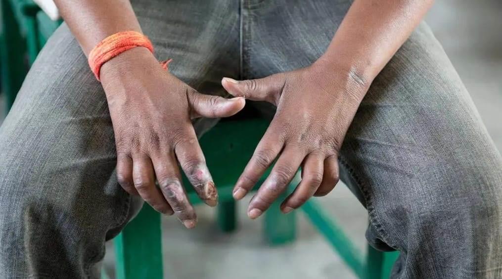 Alerta el IMSS de Veracruz sobre la lepra; estos son los síntomas