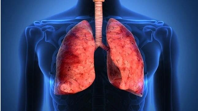 Fibrosis pulmonar, enfermedad silenciosa que ataca a miles de mexicanos