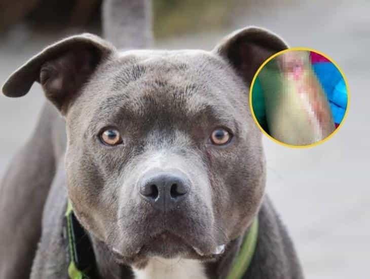 Joven sufrió ataque de un pitbull en Moloacán