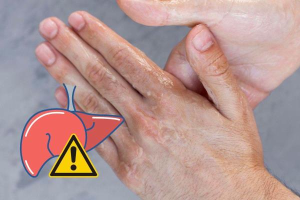 ¿Se te pelan las manos? Tu hígado puede estar funcionando mal