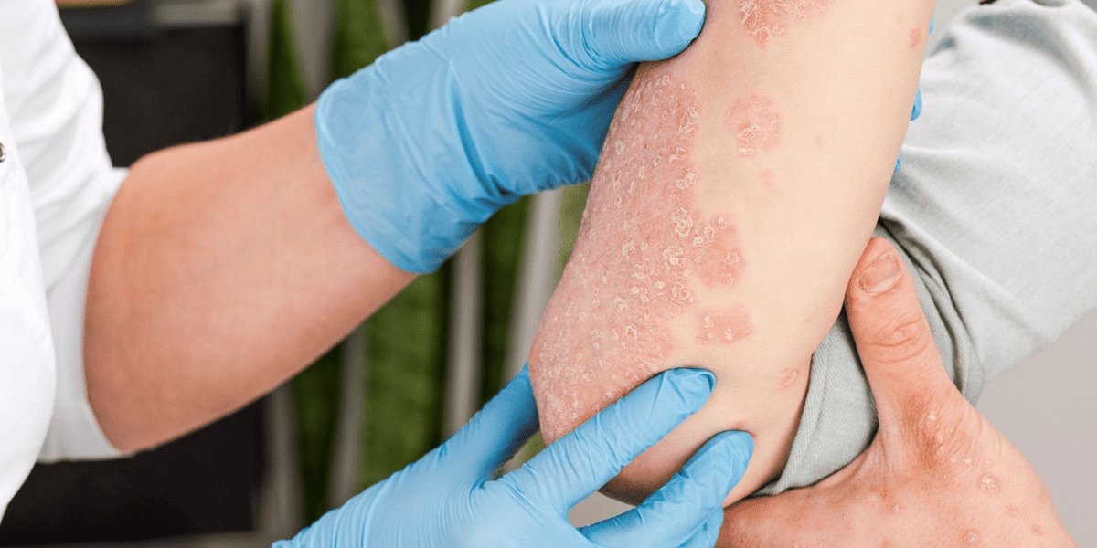 Conoce la psoriasis pustulosa, una rara enfermedad letal de la piel