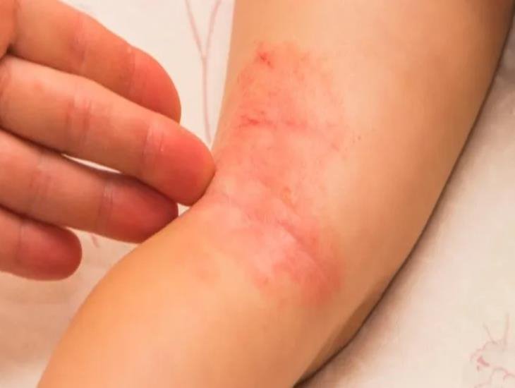 Por estas razones no se debe automedicar a niños con padecimientos dermatológicos