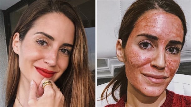 ¿Qué es un facial vampiro, procedimiento que causó VIH a 3 mujeres?