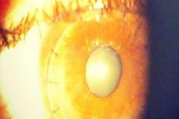 Cómo ayuda el trasplante de córnea a la recuperación de la vista; esto sabemos