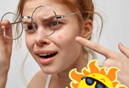 ¿Acné por el calor? ¡Líbrate de él! Te decimos cómo