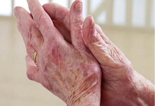 Personas con lupus deben vacunarse contra estas enfermedades por su seguridad
