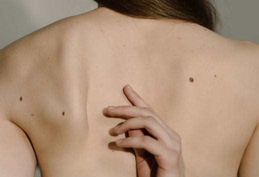 Melanoma, tipo de cáncer con el 30% de mortalidad
