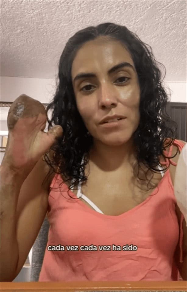Andrea revela detalles de tormenta en Pico de Orizaba donde perdió los dedos