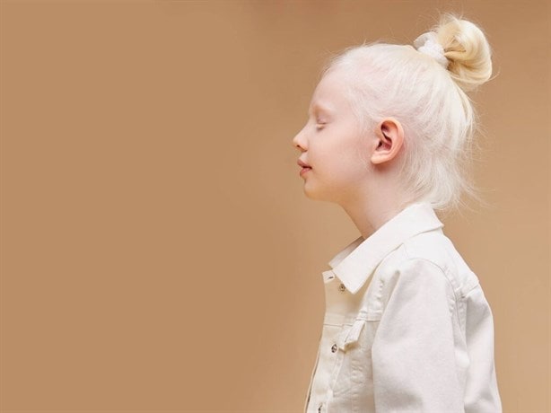 Con este método se puede detectar el albinismo humano, según la Secretaría de Salud