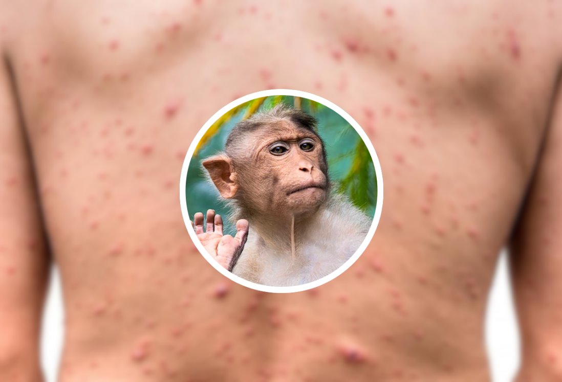 Alertan por aparición de primer caso positivo de la viruela del mono en México