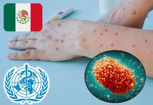 Viruela del mono: ¿cuántos casos se han registrado en México?