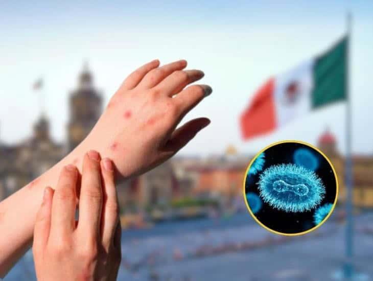 Viruela del Mono: Secretaría de salud emite recomendaciones de prevención en México