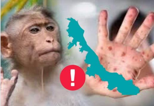 Veracruz se une a la lista: la temida viruela del mono ya está aquí