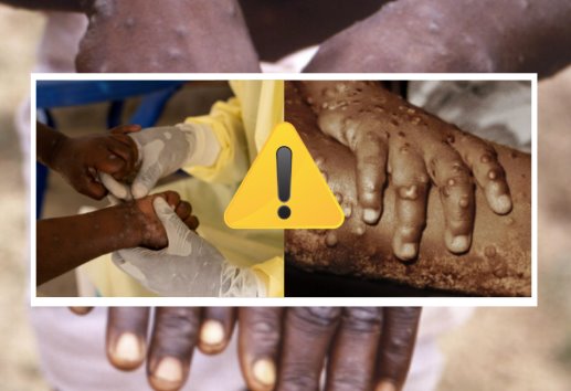 Viruela del mono: ¿Qué tan contagiosa es la nueva variante?
