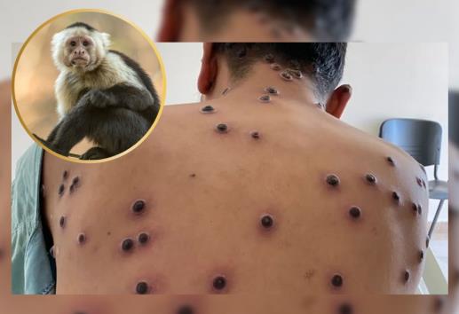 Confirman dos casos de viruela símica no activos en Veracruz
