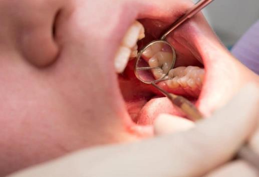 Recomienda IMSS Veracruz Norte atender caries oportunamente para evitar pérdidas dentales