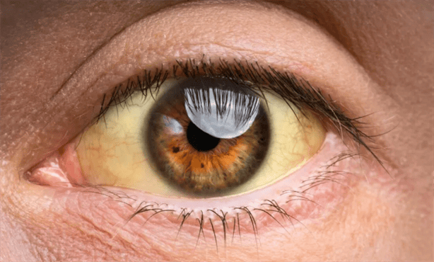 ¿Tienes los ojos amarillos?; estas son las enfermedades que podrían estar relacionadas