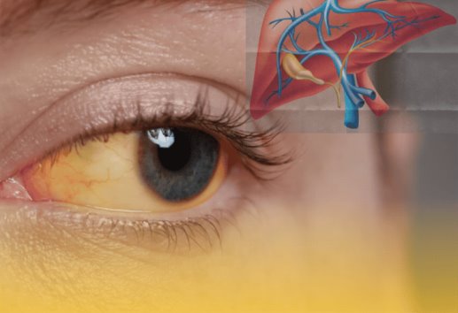 ¿Tienes los ojos amarillos?; estas son las enfermedades que podrían estar relacionadas