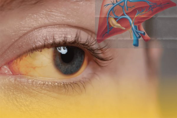 ¿Tienes los ojos amarillos?; estas son las enfermedades que podrían estar relacionadas
