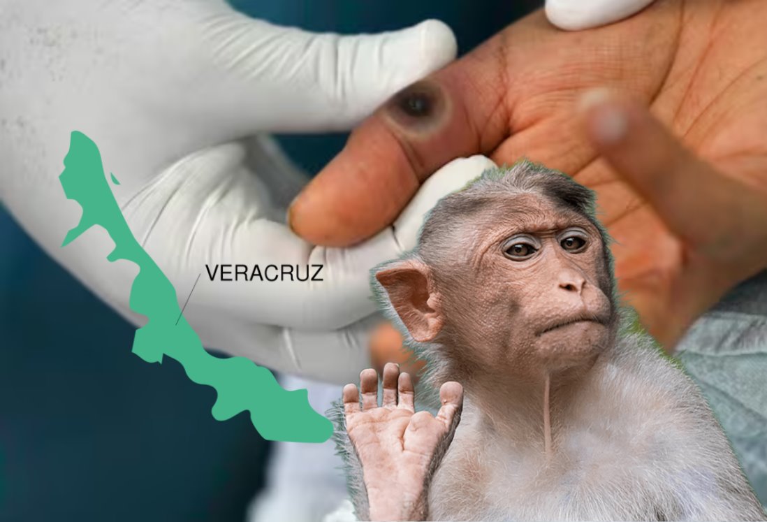 Veracruz registra tres nuevos casos de la viruela del mono