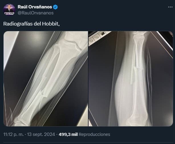 ¿Qué le pasó al Hobbit Bermúdez? Así se encuentra el futbolista tras su violenta lesión