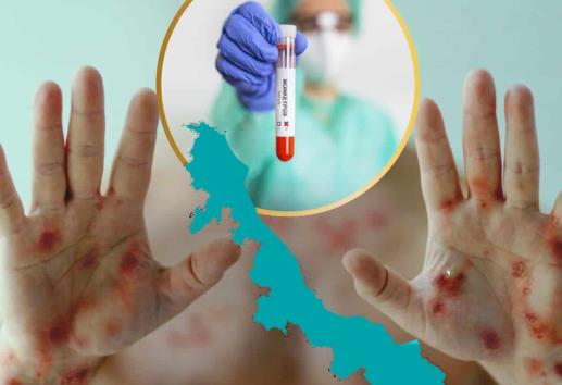 ¿A quiénes se aplicará vacuna contra viruela símica en Veracruz?; entérate