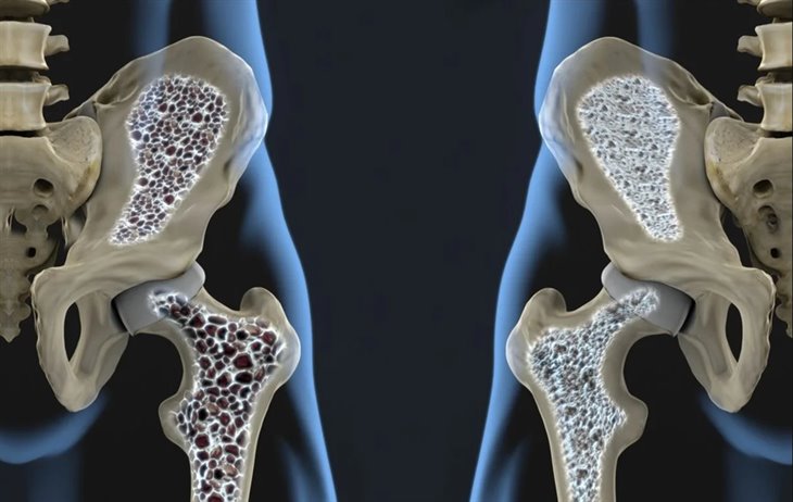 IMSS Veracruz Norte informa sobre osteoporosis; ¿qué es y cómo diagnosticarla?