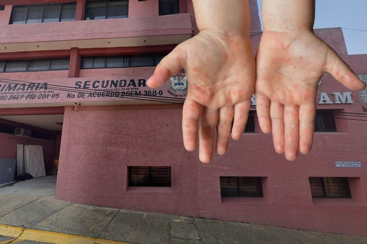 Confirman brote de Coxsackie en colegio de Coatzacoalcos ¿qué es y cómo se contagia?