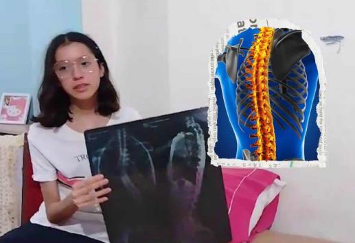 Escoliosis no deja a Dana vivir una vida normal; así la ayudarán