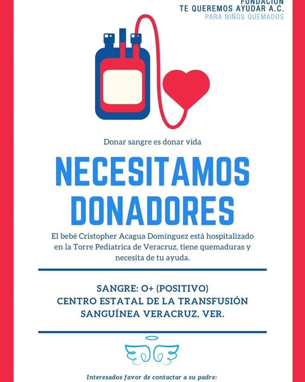 Solicitan donadores de sangre para Cristopher, niño quemado en Minatitlán