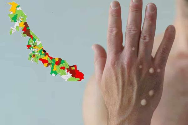 Mpox en Veracruz: 6 casos confirmados y 25 probables en 2024
