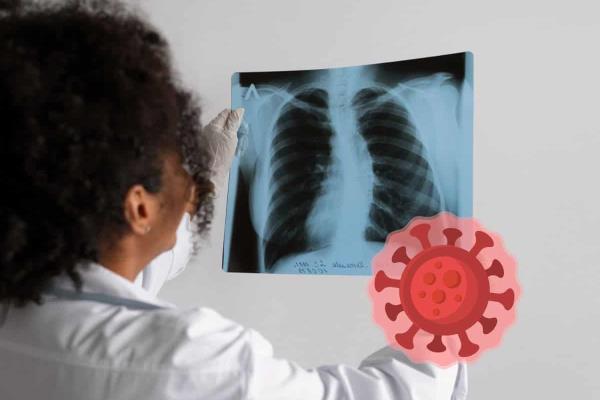 Virus HMPV: personas con secuelas de covid serían más susceptibles