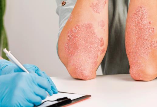 OMS alerta sobre incremento de enfermedades por hongos; son problema de salud pública
