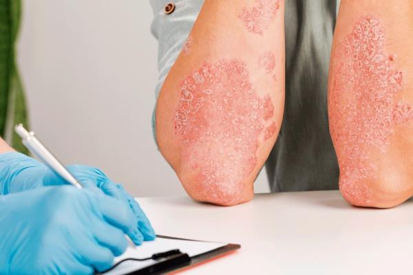 OMS alerta sobre incremento de enfermedades por hongos; son problema de salud pública
