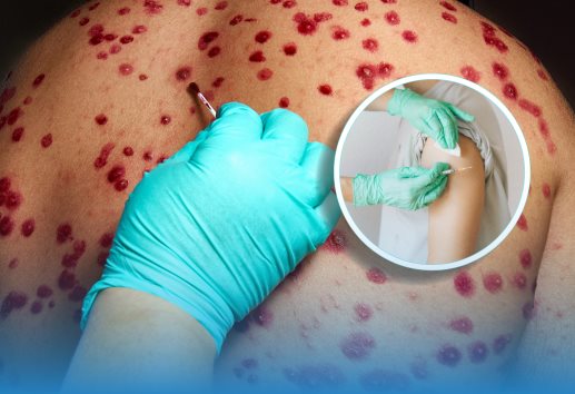 Sarampión en México: ¿quiénes deben vacunarse y cómo prevenir un brote mayor?